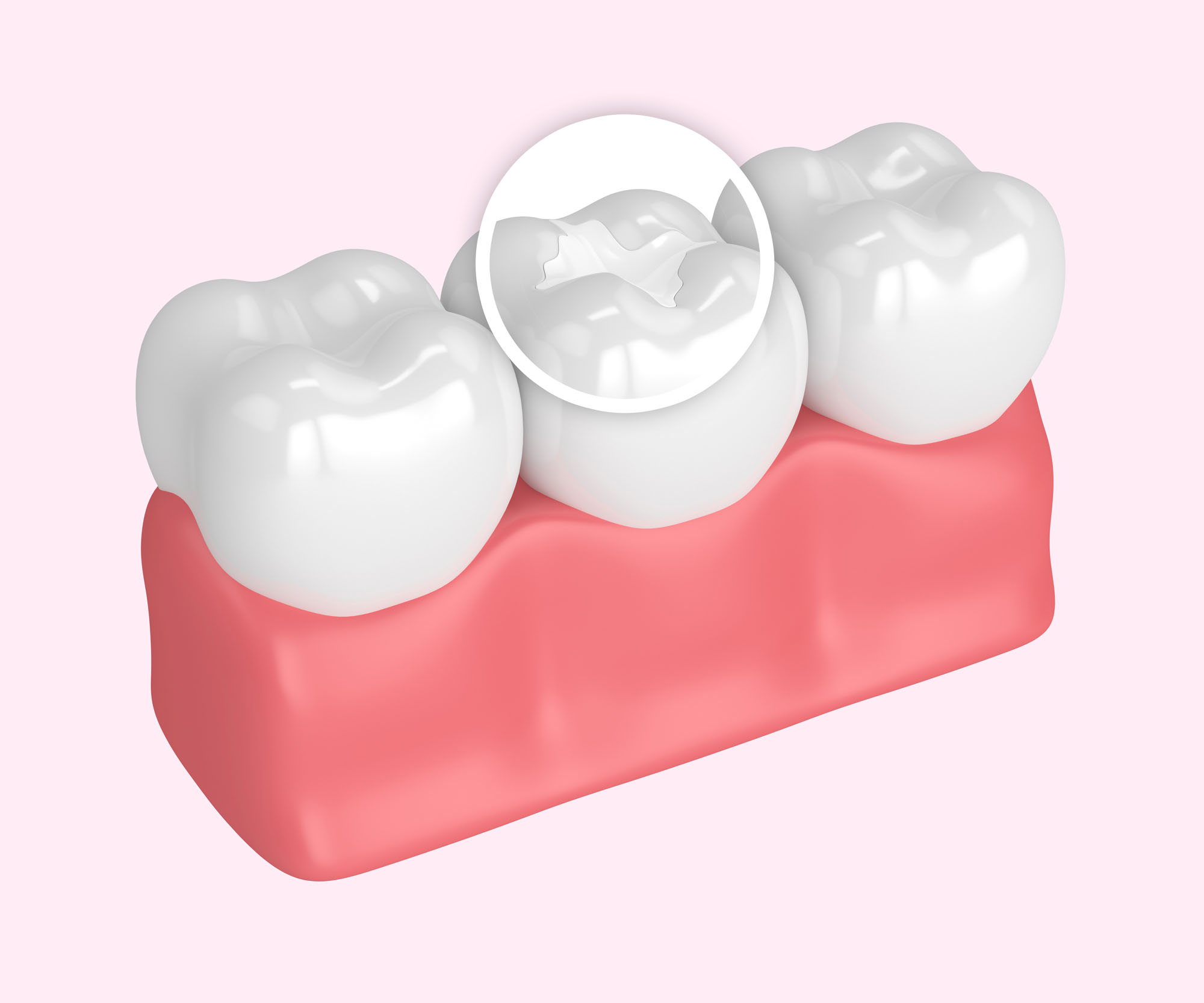3d render of teeth with dental composite filling | Children's Dentistry of Elko